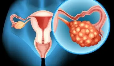 روش‌های مدرن برای کاهش خطر ابتلا به سرطان تخمدان