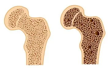 نقش الگوهای غذایی در پیشگیری و کنترل پوکی استخوان