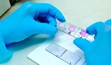 درباره بیوپسی یا نمونه برداری دهان بیشتر بدانید