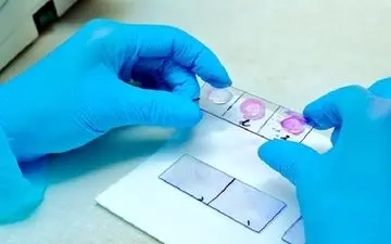 درباره بیوپسی یا نمونه برداری دهان بیشتر بدانید