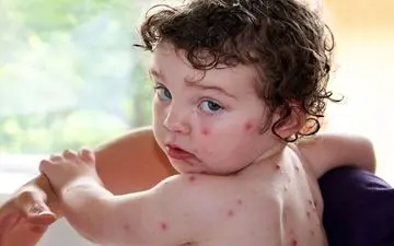 آبله مرغان؛ چه علائمی دارد؟| آیا این ویروس درمان دارویی هم دارد؟