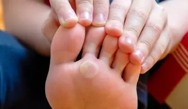 با تاول پا چه کنیم؟