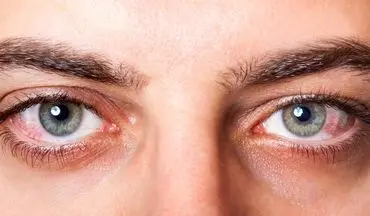 چه ویتامین‌هایی برای خشکی چشم مفید هستند؟