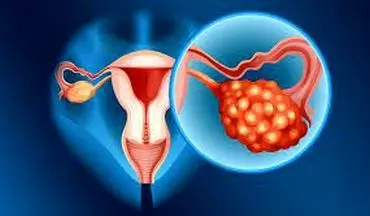 علل تنبلی تخمدان و علایم سندرم تخمدان پلی کیستیک
