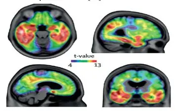 توسعه آزمایش خونی جدید برای تشخیص آلزایمر 