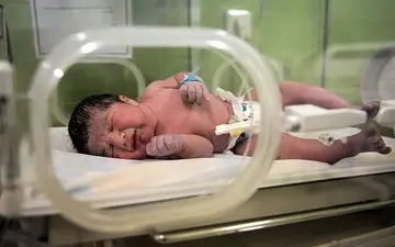 سزارین؛کاهش یا افزایش