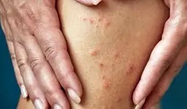 نشانه ها و علایم بیماری گال! | حتما بخوانید