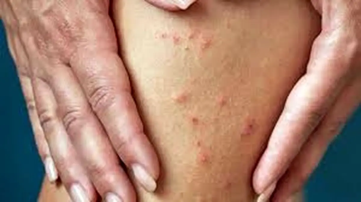 نشانه ها و علایم بیماری گال! | حتما بخوانید