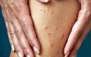 نشانه ها و علایم بیماری گال! | حتما بخوانید