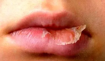 خشکی دهان نشان دهنده کدام بیماری است؟