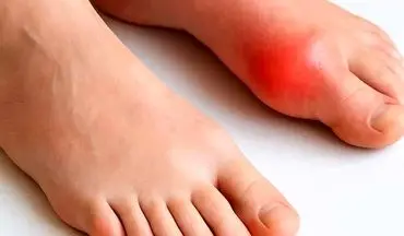 نقرس چیست و چه عواملی باعث بروز این بیماری می شود؟