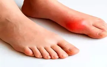 نقرس چیست و چه عواملی باعث بروز این بیماری می شود؟