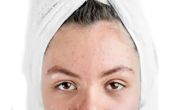 جوش پیشانی: چرا به وجود می‌آید و چه راه‌هایی برای مقابله با آن وجود دارد؟