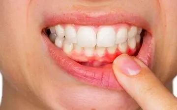 احتمال ابتلا به زوال عقل درصورت داشتن لثه‌های ناسالم 