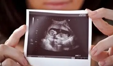 تشخیص زودهنگام «سندرم داون» از روی استخوان بینی!!