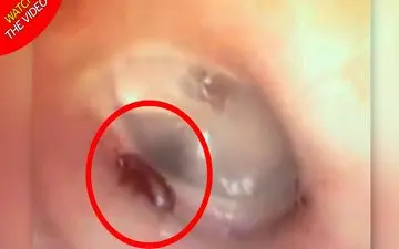 لحظه خارج کردن مورچه از گوش بیمار! +فیلم 