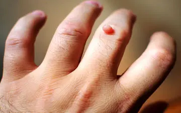 بهترین درمان برای زگیل پوستی