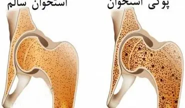 پوکی استخوان و آرتروز زانو؛ راهکارهای پیشگیری و درمان