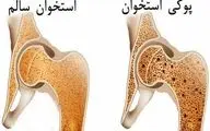 پوکی استخوان و آرتروز زانو؛ راهکارهای پیشگیری و درمان