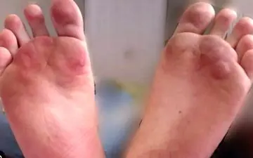 آیا میدانید علت تاول چیست؟| دلایل و درمان تاول