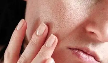 با این ویتامین صورت تان پر می شود