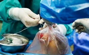 اهدای عضو در یزد، نجات‌بخش جان بیماران شد