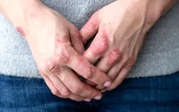 رابطه پسوریازیس و بیماری قلبی 

