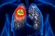سرطان ریه؛ بیماری‌ای که بی‌صدا می‌آید و جان می‌گیرد