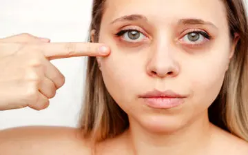 سیاهی دور چشم در بارداری نشانه چیست؟