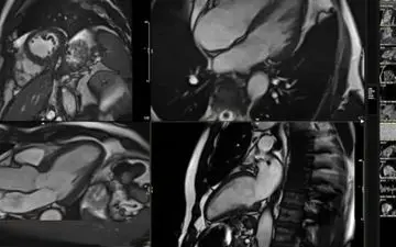 می خواهید بدانید عمر قلب تان چقدر است؟