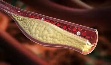 هر آنچه که لازم است در مورد کلسترول بالا بدانید