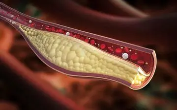 هر آنچه که لازم است در مورد کلسترول بالا بدانید