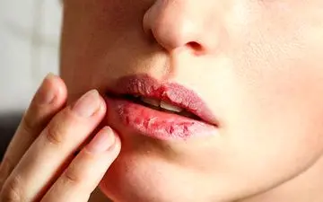 خشک شدن لب در رمضان؛ با این ترفندهایی که میگم خشکی لبت رو برطرف کن

