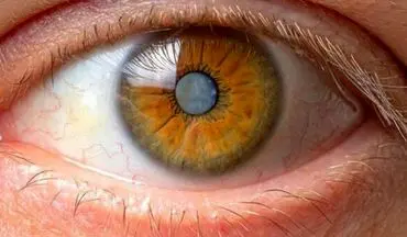 علائم آب مروارید کدامند؟
