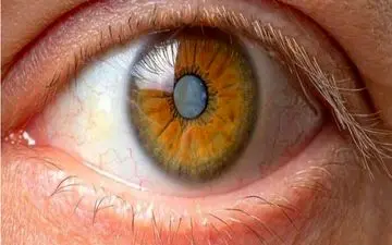 علائم آب مروارید کدامند؟
