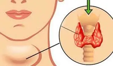 علائم مهم کم‌کاری تیروئید!