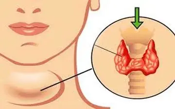 علائم مهم کم‌کاری تیروئید!