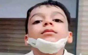 وحشت در کلاس درس؛ معلم کهنوجی با سیلی فک دانش‌آموز شش ساله را شکست+عکس 
