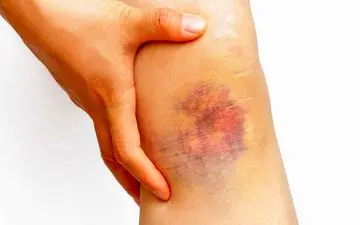 کبودی پوست نشانه یک بیماری است