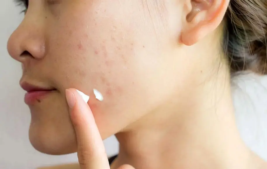 از بین بردن لک صورت با خمیردندان