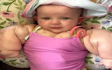 عجیب اما واقعی| این نوزاد شبیه هالک به دنیا آمد