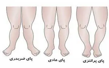 ایجاد پای پرانتزی و صافی کف پا در کودکان به چه علت است؟