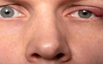 علائم بلفاریت چشم چیست؟