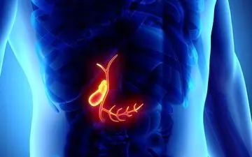 سنگ صفراوی را با طب سنتی درمان کنید