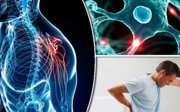 درمان ام اس در طب سنتی