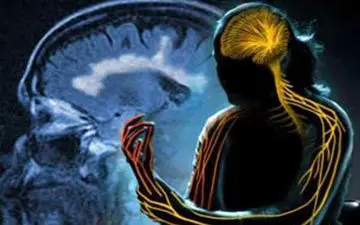 علائم اولیه ابتلا به ام اس