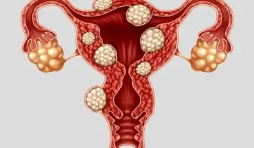 خانم های عزیز اندومتریوز  را جدی بگیرید!