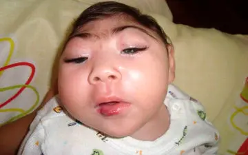 آنسفالی چگونه تشخیص داده می‌شود؟