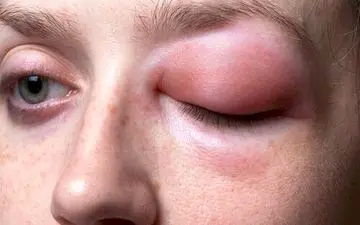 آنژیوادم کهیری ساده اما خطرناک!