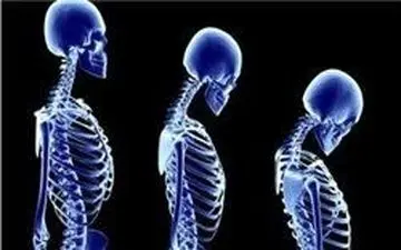 شانه‌های یخ زده |  بیماری شانه‌‌های یخ زده چیست و چه علائمی دارد؟